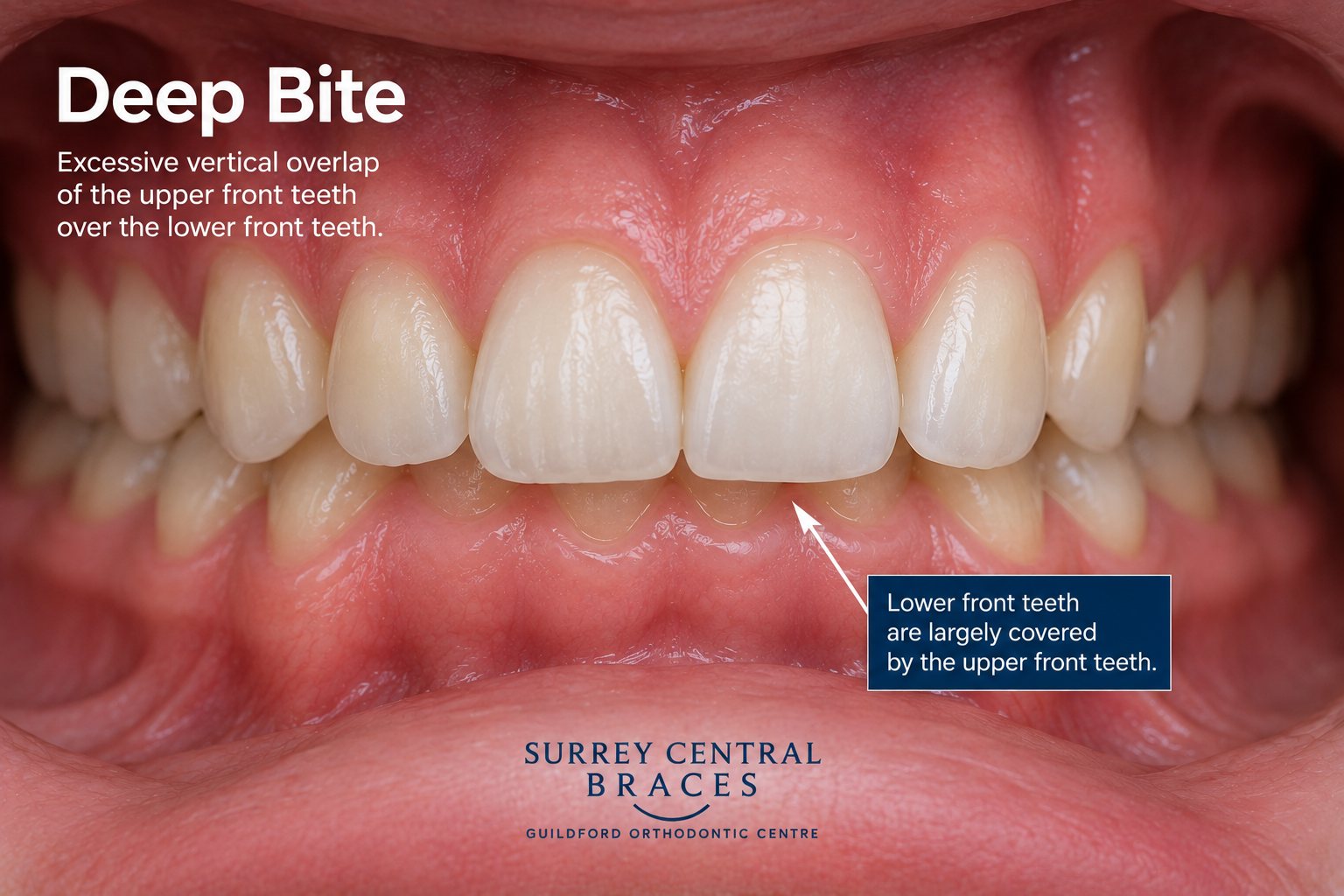 Front-view orthodontic diagram showing a deep bite with excessive vertical overlap of the upper front teeth over the lower front teeth.