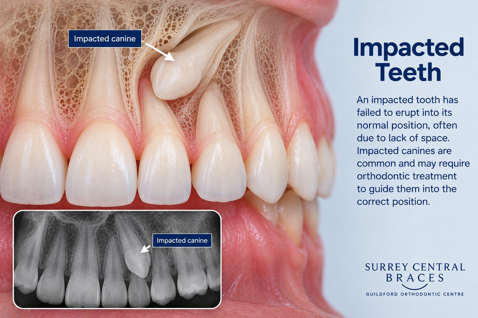 Orthodontic infographic showing an impacted upper canine and its relationship to the adjacent teeth.