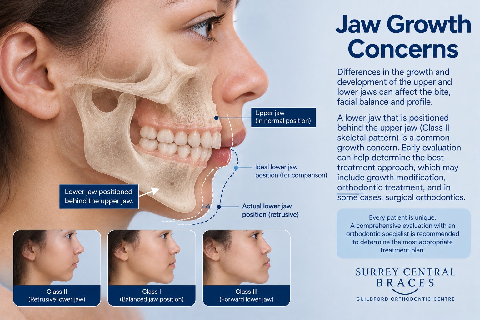 Profile orthodontic diagram showing a Class II jaw growth discrepancy with the lower jaw positioned behind the upper jaw.