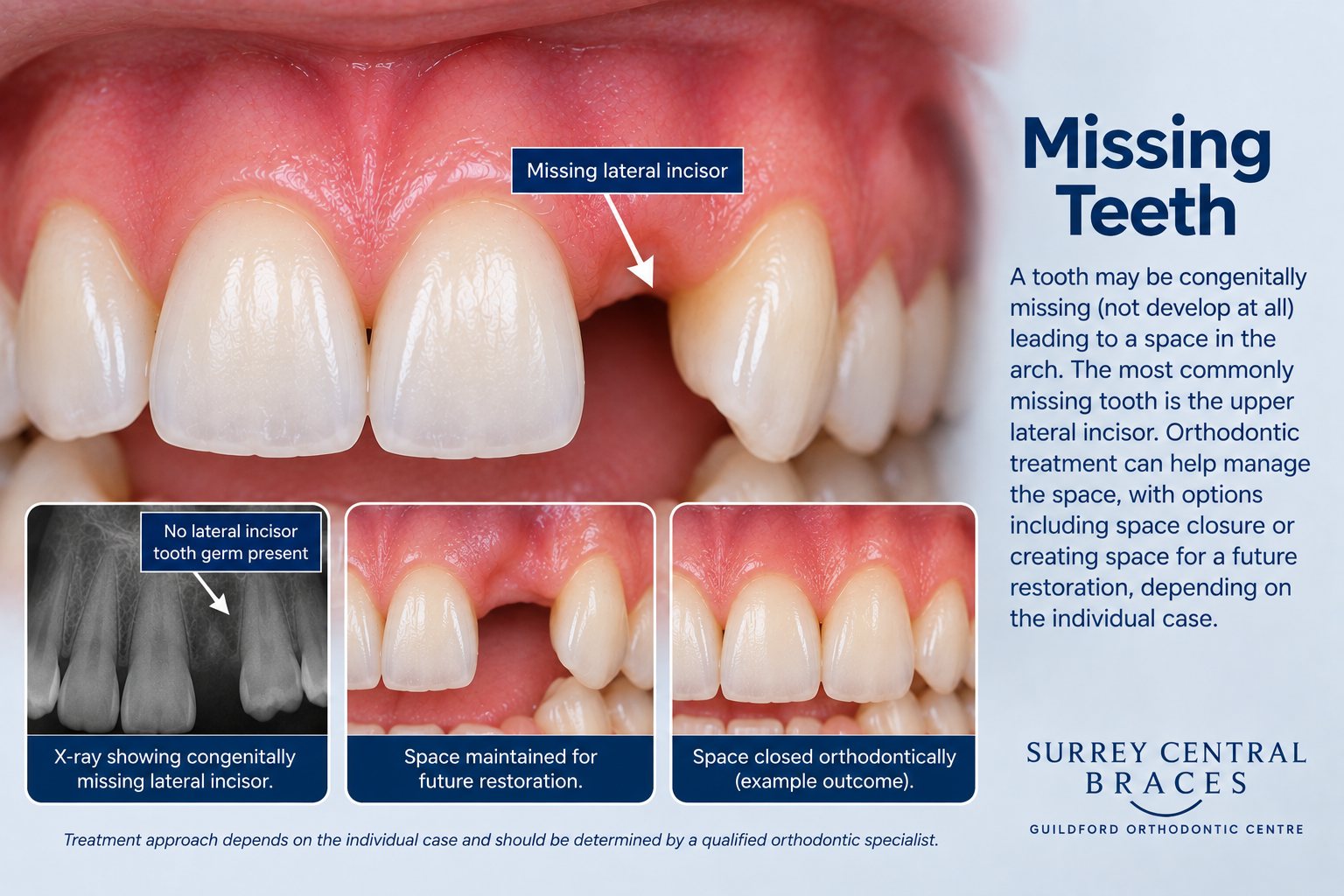 Orthodontic infographic showing a congenitally missing upper lateral incisor and options for orthodontic space management.