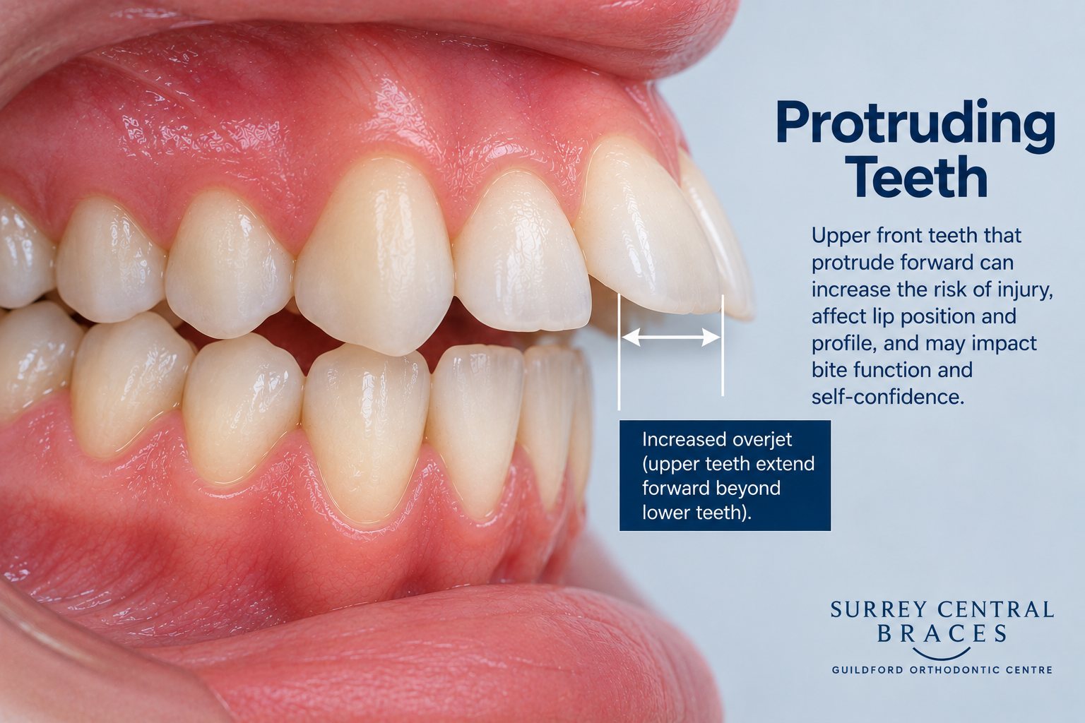 Side-view orthodontic diagram showing protruding upper front teeth and increased overjet.