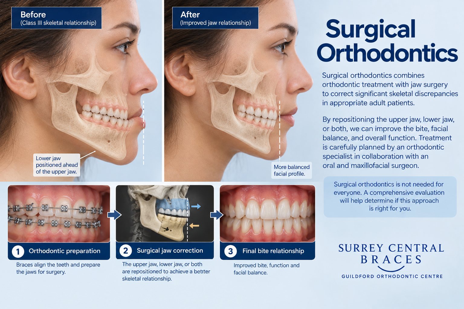 Educational surgical orthodontics infographic showing orthodontic preparation, jaw correction and the planned final bite relationship.