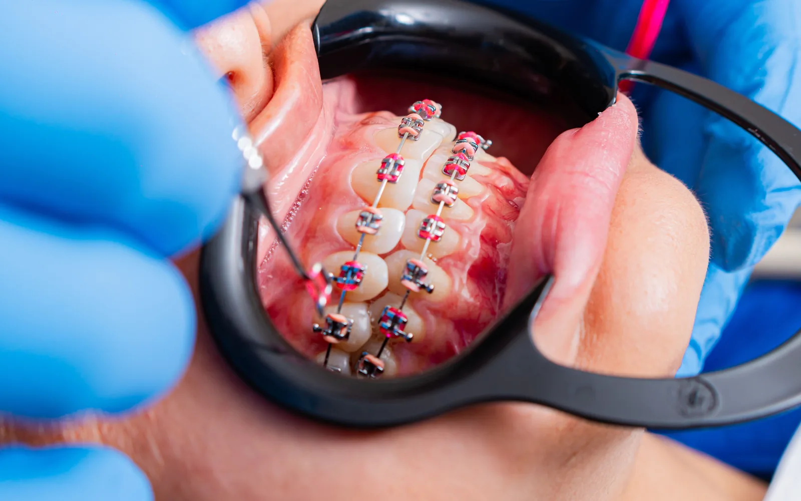 Close-up of orthodontic braces being examined during treatment