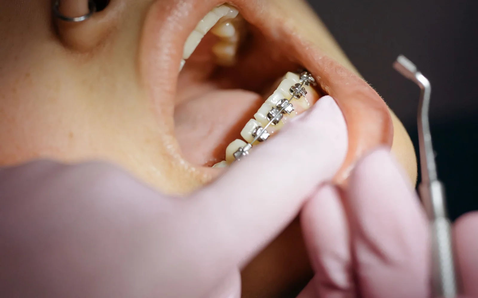 Orthodontic braces being examined during a clinical treatment appointment